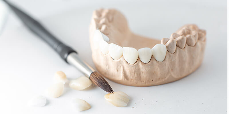 Metallfreie Alternativen für Zahnersatz