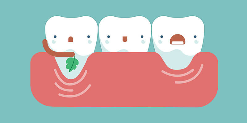 Alle Informationen über Zahnfleischrückgang