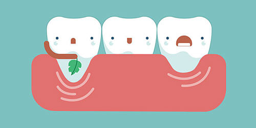 Zahnfleischrückgang- Symptome, Ursachen, Risiken, Behandlung und Prävention