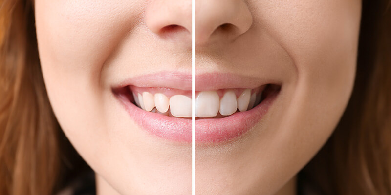 Zahnfleischwucherungen – Symptome, Ursachen, Folgen und Behandlung